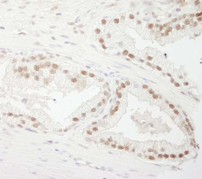 Detection of Human CSTF77 by Immunohistochemistry. Sample: FFPE section of human prostate carcinoma. Antibody: Affinity purified rabbit anti-CSTF77 used at a dilution of 1:250.