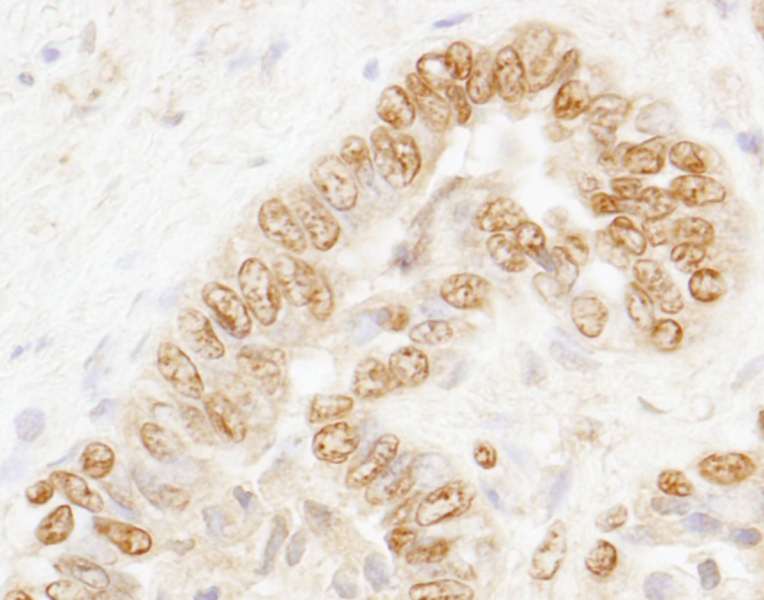 Detection of Human CSTF77 by Immunohistochemistry. Sample: FFPE section of human prostate carcinoma. Antibody: Affinity purified rabbit anti-CSTF77 used at a dilution of 1:200 (1 ug/ml). Detection: DAB.