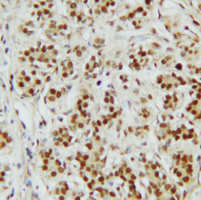 CTBP2 antibody. IHC(P):Human Breast Cancer Tissue.