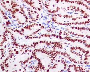IHC of paraffin-embedded human thyroid carcinoma tissue using anti-CTBP2 antibody.