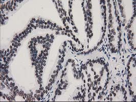 IHC of paraffin-embedded Carcinoma of Human prostate tissue using anti-CTDSP1 mouse monoclonal antibody. (Heat-induced epitope retrieval by 10mM citric buffer, pH6.0, 100C for 10min).