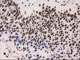 IHC of paraffin-embedded Carcinoma of Human bladder tissue using anti-CTDSP1 mouse monoclonal antibody. (Heat-induced epitope retrieval by 10mM citric buffer, pH6.0, 100C for 10min).
