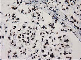 IHC of paraffin-embedded Adenocarcinoma of Human colon tissue using anti-CTDSP1 mouse monoclonal antibody. (Heat-induced epitope retrieval by 10mM citric buffer, pH6.0, 100C for 10min).