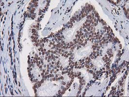 IHC of paraffin-embedded Carcinoma of Human prostate tissue using anti-CTDSP1 mouse monoclonal antibody.