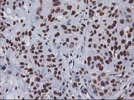 IHC of paraffin-embedded Carcinoma of Human bladder tissue using anti-CTDSP1 mouse monoclonal antibody.