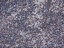 IHC of paraffin-embedded Human lymphoma tissue using anti-CTDSP1 mouse monoclonal antibody.