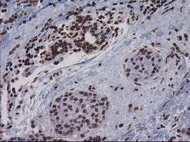 IHC of paraffin-embedded Adenocarcinoma of Human breast tissue using anti-CTDSP1 mouse monoclonal antibody.