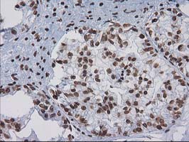 IHC of paraffin-embedded Adenocarcinoma of Human ovary tissue using anti-CTDSP1 mouse monoclonal antibody.