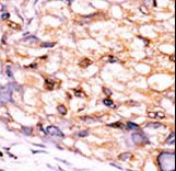 Formalin-fixed and paraffin-embedded human cancer tissue reacted with the primary antibody, which was peroxidase-conjugated to the secondary antibody, followed by DAB staining. This data demonstrates the use of this antibody for immunohistochemistry; clinical relevance has not been evaluated. BC = breast carcinoma; HC = hepatocarcinoma.