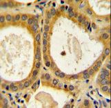IDDM12 Antibody immunohistochemistry of formalin-fixed and paraffin-embedded human prostate carcinoma followed by peroxidase-conjugated secondary antibody and DAB staining.