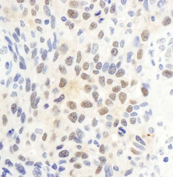 Detection of Human CTR9 by Immunohistochemistry. Sample: FFPE section of human ovarian carcinoma. Antibody: Affinity purified rabbit anti-CTR9 used at a dilution of 1:1000 (1 ug/ml). Detection: DAB.