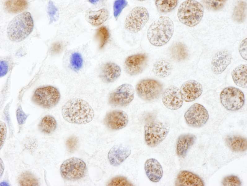 Detection of Human CTR9 by Immunohistochemistry. Sample: FFPE section of human breast carcinoma. Antibody: Affinity purified rabbit anti-CTR9 used at a dilution of 1:250.