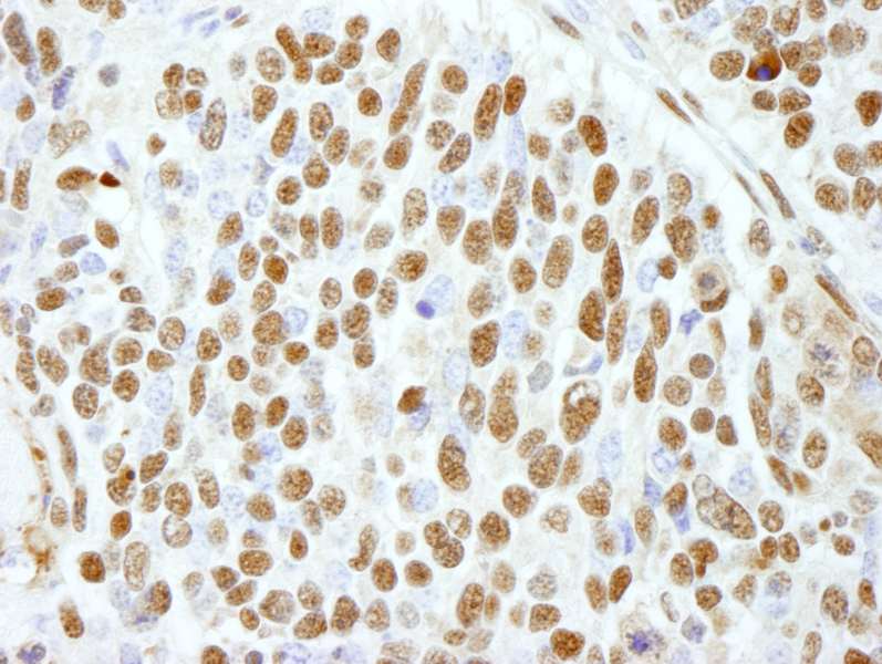 Detection of Human CTR9 by Immunohistochemistry. Sample: FFPE section of human breast carcinoma. Antibody: Affinity purified rabbit anti-CTR9 used at a dilution of 1:250.