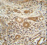 CTSA antibody immunohistochemistry of formalin-fixed and paraffin-embedded human hepatocarcinoma followed by peroxidase-conjugated secondary antibody and DAB staining.