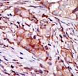 Formalin-fixed and paraffin-embedded human cancer tissue reacted with the primary antibody, which was peroxidase-conjugated to the secondary antibody, followed by AEC staining. This data demonstrates the use of this antibody for immunohistochemistry; clinical relevance has not been evaluated. BC = breast carcinoma; HC = hepatocarcinoma.