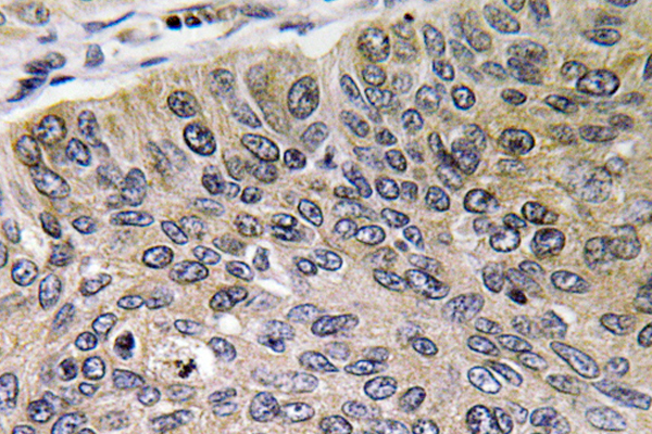 IHC of Cathepsin E (I292) pAb in paraffin-embedded human lung carcinoma tissue.