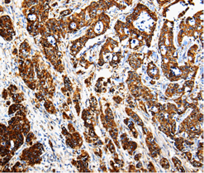 Immunohistochemistry of paraffin-embedded human pancreatic cancer tissue using CTSE antibody.