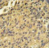 CTSH Antibody IHC of formalin-fixed and paraffin-embedded human hepatocarcinoma followed by peroxidase-conjugated secondary antibody and DAB staining.