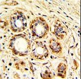 Formalin-fixed and paraffin-embedded human breast carcinoma with CTSK Antibody (Center R222), which was peroxidase-conjugated to the secondary antibody, followed by DAB staining. This data demonstrates the use of this antibody for immunohistochemistry; clinical relevance has not been evaluated.