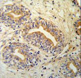 CWC15 Antibody IHC of formalin-fixed and paraffin-embedded prostate carcinoma followed by peroxidase-conjugated secondary antibody and DAB staining.