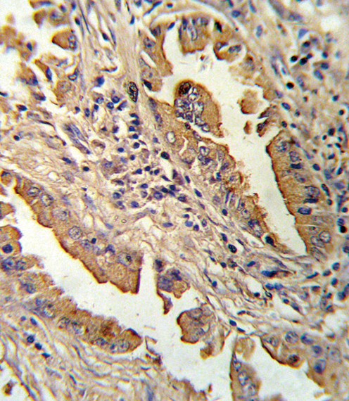 Formalin-fixed and paraffin-embedded human lung carcinoma reacted with IL8 Antibody , which was peroxidase-conjugated to the secondary antibody, followed by DAB staining. This data demonstrates the use of this antibody for immunohistochemistry; clinical relevance has not been evaluated.