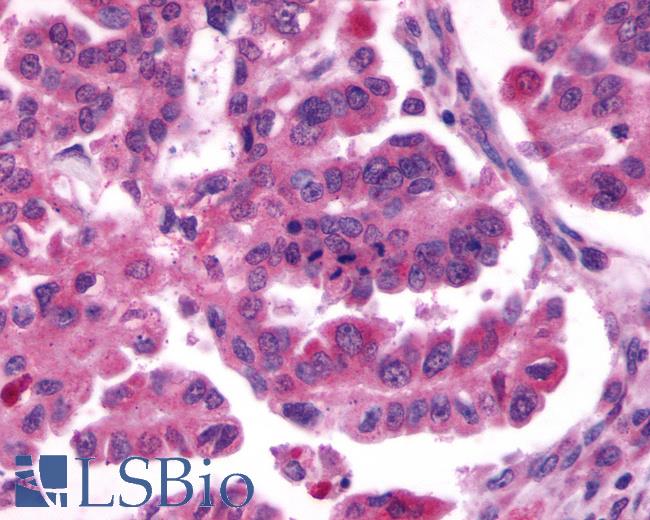 Anti-CXCR4 antibody IHC of human Ovary, Carcinoma. Immunohistochemistry of formalin-fixed, paraffin-embedded tissue after heat-induced antigen retrieval.