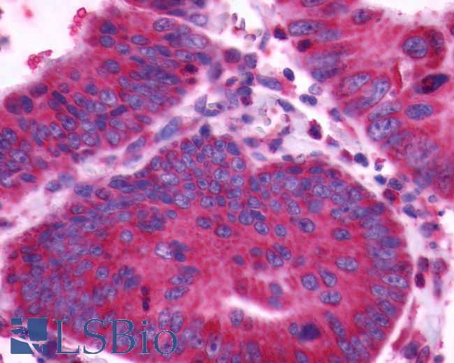 Anti-CXCR4 antibody IHC of human Colon, Carcinoma. Immunohistochemistry of formalin-fixed, paraffin-embedded tissue after heat-induced antigen retrieval.