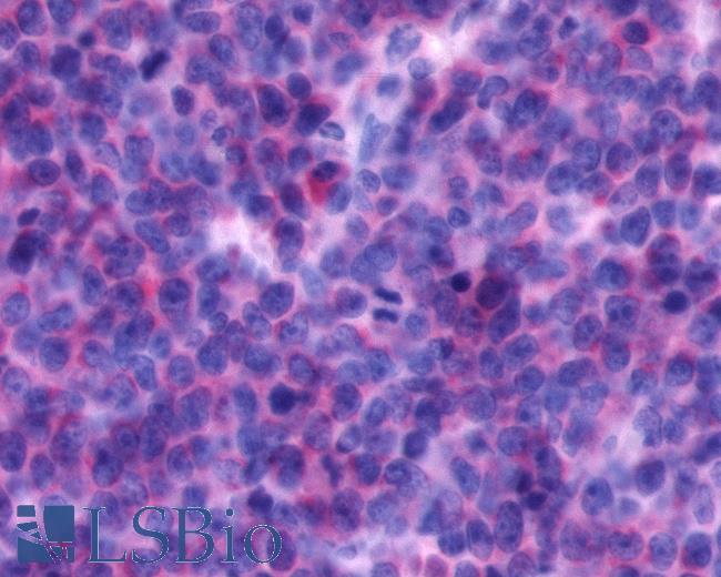 Anti-CXCR4 antibody IHC of human Lymph Node, Non-Hodgkins Lymphoma. Immunohistochemistry of formalin-fixed, paraffin-embedded tissue after heat-induced antigen retrieval.