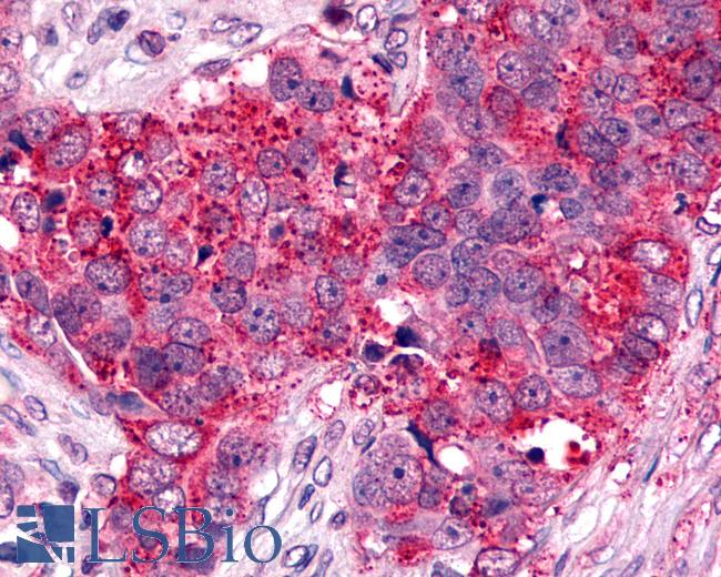Anti-CXCR6 antibody IHC of human Ovary, Carcinoma. Immunohistochemistry of formalin-fixed, paraffin-embedded tissue after heat-induced antigen retrieval.