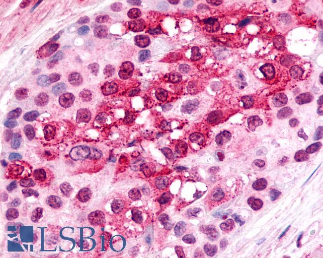 Anti-CXCR6 antibody IHC of human Breast, Carcinoma. Immunohistochemistry of formalin-fixed, paraffin-embedded tissue after heat-induced antigen retrieval.