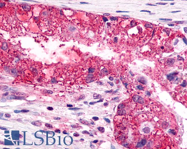 Anti-CXCR6 antibody IHC of human Lung, Adenocarcinoma. Immunohistochemistry of formalin-fixed, paraffin-embedded tissue after heat-induced antigen retrieval.