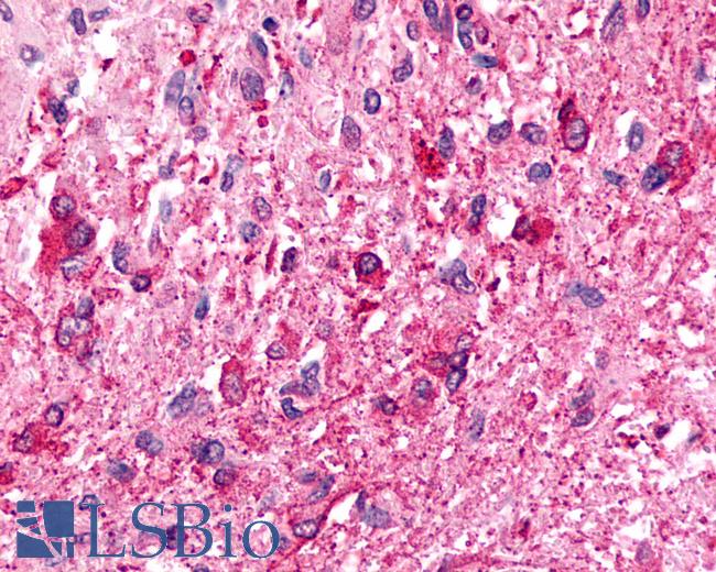 Anti-CXCR6 antibody IHC of human Brain, Glioblastoma. Immunohistochemistry of formalin-fixed, paraffin-embedded tissue after heat-induced antigen retrieval.
