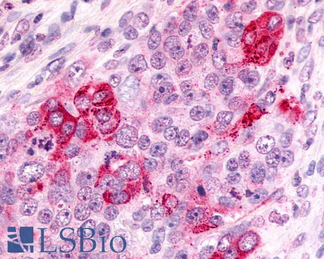 Anti-CXCR6 antibody IHC of human Ovary, Carcinoma. Immunohistochemistry of formalin-fixed, paraffin-embedded tissue after heat-induced antigen retrieval.