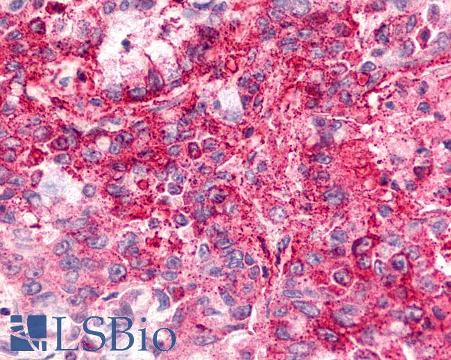 Anti-CXCR6 antibody IHC of human Lung, Adenocarcinoma. Immunohistochemistry of formalin-fixed, paraffin-embedded tissue after heat-induced antigen retrieval.