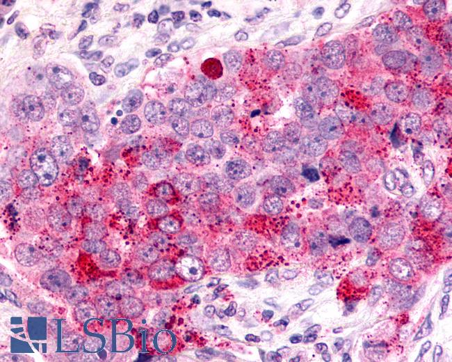 Anti-CXCR6 antibody IHC of human Ovary, Carcinoma. Immunohistochemistry of formalin-fixed, paraffin-embedded tissue after heat-induced antigen retrieval.