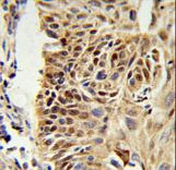 CIRBP Antibody IHC of formalin-fixed and paraffin-embedded human lung carcinoma followed by peroxidase-conjugated secondary antibody and DAB staining.