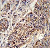 CYC1 Antibody immunohistochemistry of formalin-fixed and paraffin-embedded human lung carcinoma followed by peroxidase-conjugated secondary antibody and DAB staining.