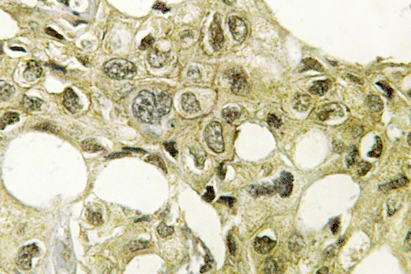 IHC of CYP17A1 (N249) pAb in paraffin-embedded human breast carcinoma tissue.