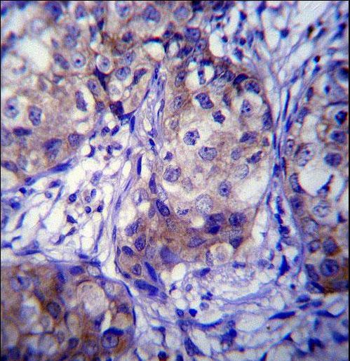 CYP1A1 Antibody immunohistochemistry of formalin-fixed and paraffin-embedded human breast carcinoma followed by peroxidase-conjugated secondary antibody and DAB staining.