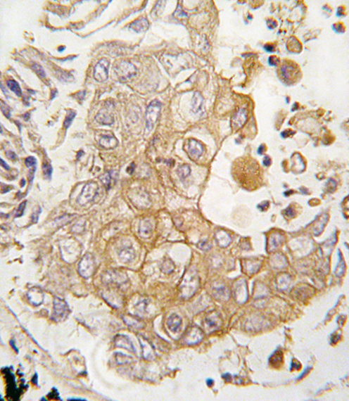 Formalin-fixed and paraffin-embedded human lung carcinoma tissue reacted with CYP1A1 antibody , which was peroxidase-conjugated to the secondary antibody, followed by DAB staining. This data demonstrates the use of this antibody for immunohistochemistry; clinical relevance has not been evaluated.