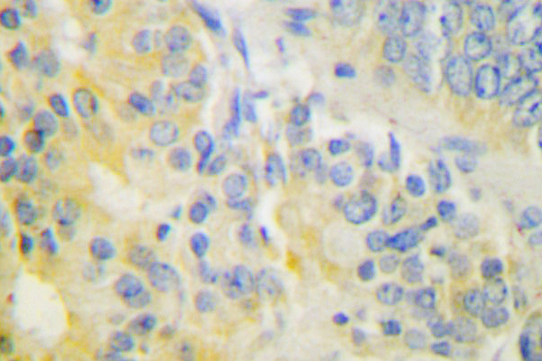 IHC of CYP24A1 (R439) pAb in paraffin-embedded human prostate carcinoma tissue.