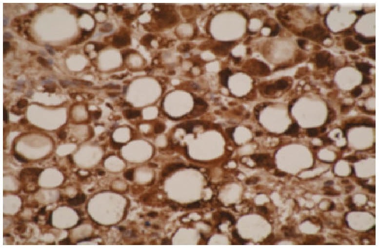 A. IHC of liposarcoma cells using CYP26A1 antibody (LS-B2916). B. Western blot on recombinant protein corresponding to C-terminal region of CYP26A1 protein using CYP26A1 antibody.