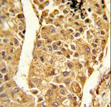Formalin-fixed and paraffin-embedded human hepatocarcinoma reacted with CYP2C18 Antibody ,which was peroxidase-conjugated to the secondary antibody, followed by DAB staining. This data demonstrates the use of this antibody for immunohistochemistry; clinical relevance has not been evaluated.
