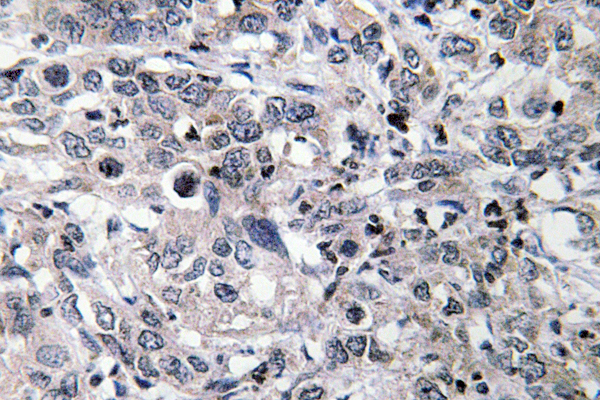 IHC of CYP2C19 (K270) pAb in paraffin-embedded human liver carcinoma tissue.