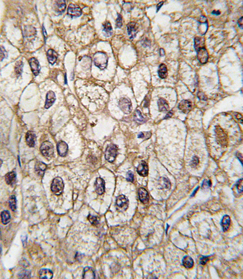 Formalin-fixed and paraffin-embedded human hepatocarcinoma tissue reacted with CYP2C9 antibody , which was peroxidase-conjugated to the secondary antibody, followed by DAB staining. This data demonstrates the use of this antibody for immunohistochemistry; clinical relevance has not been evaluated.