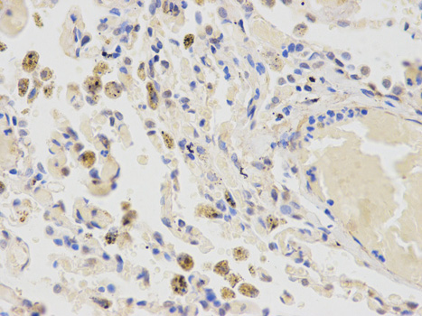 Immunohistochemistry of paraffin-embedded human lung cancer using CYP2E1 antibody at dilution of 1:100 (400x lens).