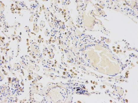 Immunohistochemistry of paraffin-embedded human lung cancer using CYP2E1 antibody at dilution of 1:100 (200x lens).