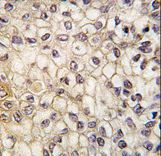 Formalin-fixed and paraffin-embedded human lung carcinoma tissue reacted with CYP2F1 antibody , which was peroxidase-conjugated to the secondary antibody, followed by DAB staining. This data demonstrates the use of this antibody for immunohistochemistry; clinical relevance has not been evaluated.