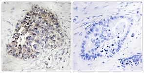 IHC of paraffin-embedded human lung carcinoma tissue, using Cytochrome P450 2S1 Antibody. The picture on the right is treated with the synthesized peptide.