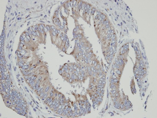 IHC of paraffin-embedded mixed OVCA using CYP4A11 antibody at 1:100 dilution.